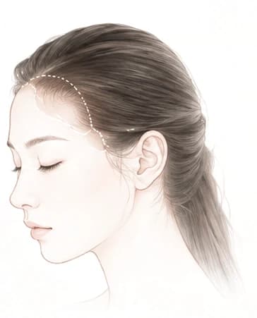 髮際線示意插圖