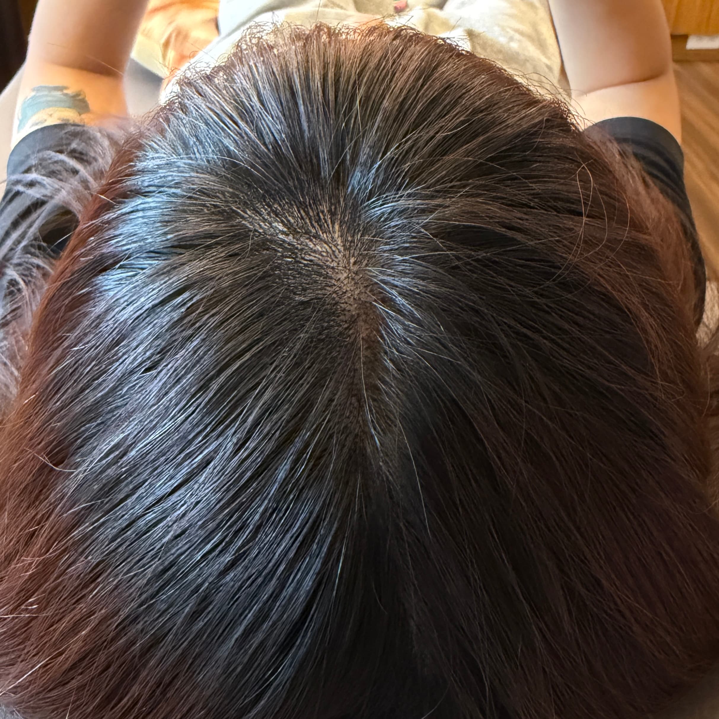 頭頂分線|術後